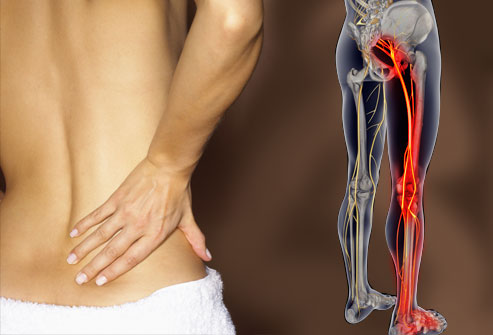 what-is-sciatica